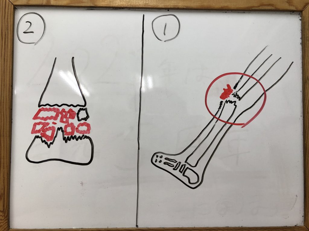 開放性骨折と粉砕骨折