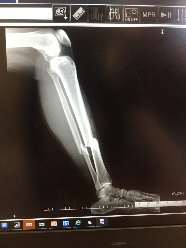 脛骨腓骨骨幹部骨折の写真１